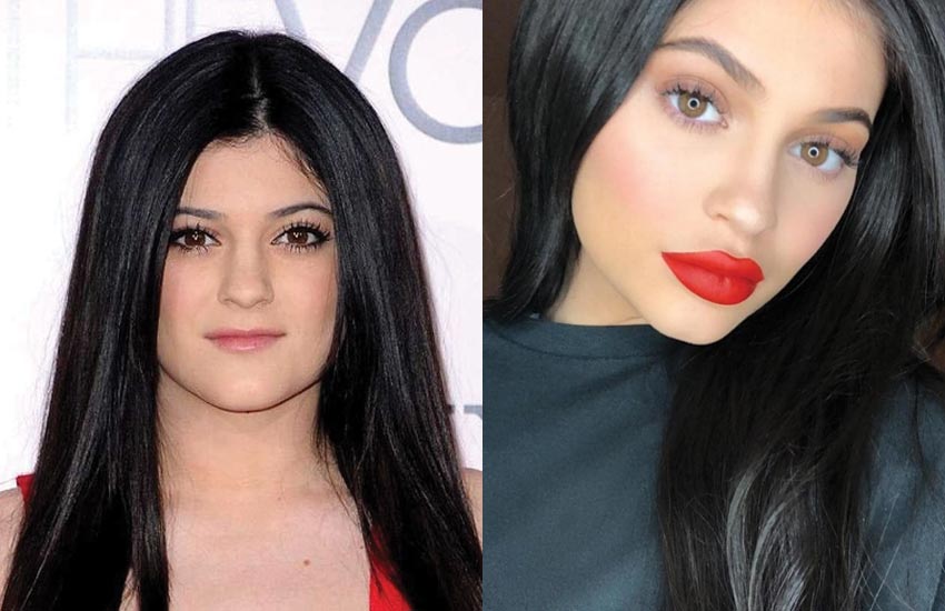 kylie-jenner-lips-before-after-fillers-injections-plastic-surgery